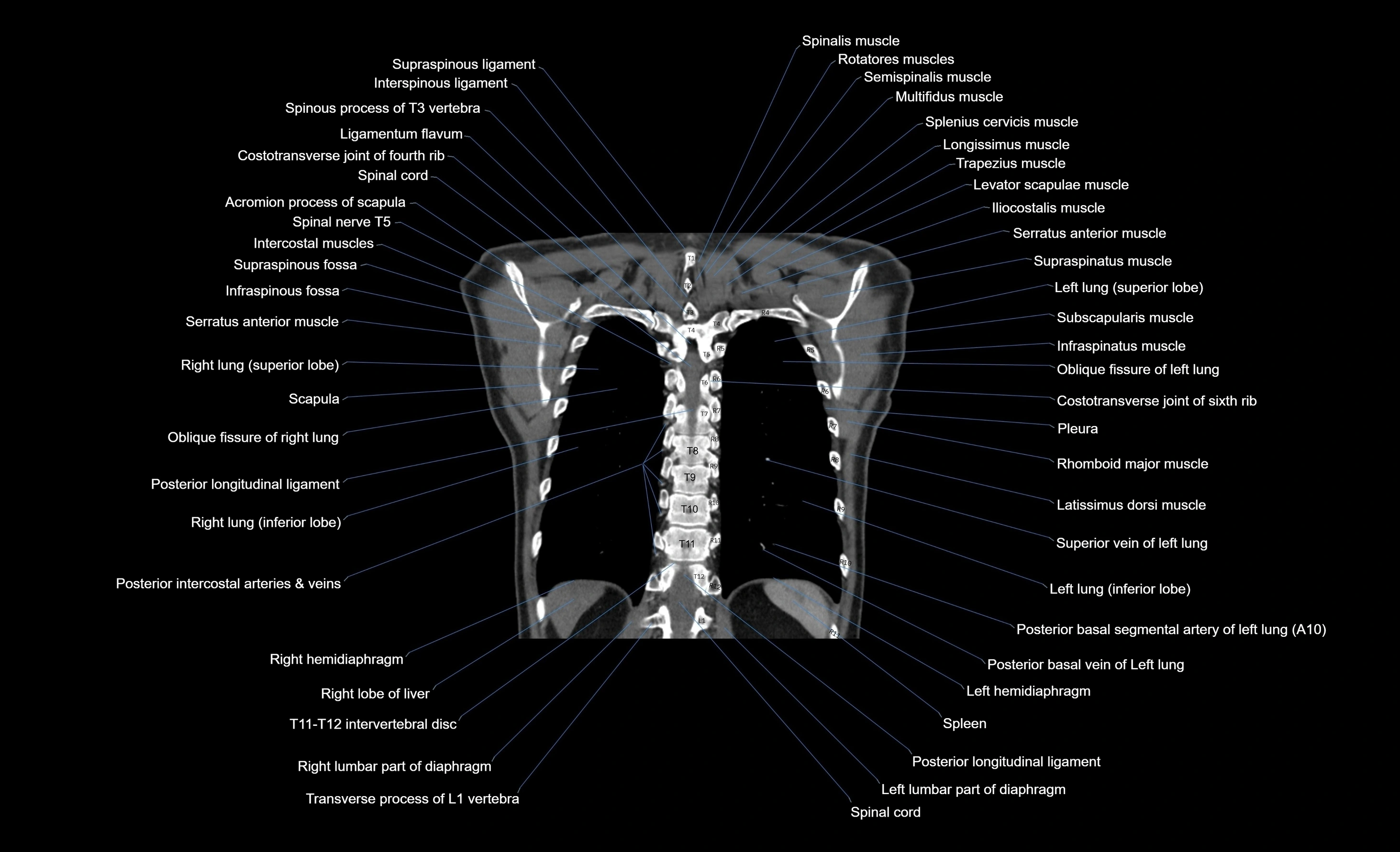 CT chest (thorax) soft tissue window labelled coronal cross sectional anatomy radiology image-00027.webp